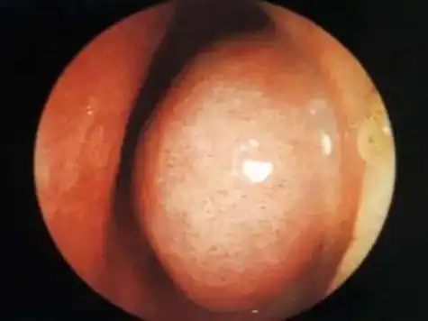 引起的鼻甲黏膜水肿,肥厚,增生,导致鼻腔阻塞