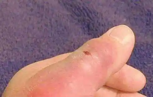 被毒蜘蛛咬后的症状及图片