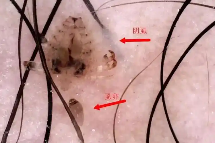 阴虱小颗粒虫卵图片