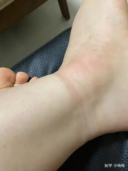 脚崴了到底有多痛