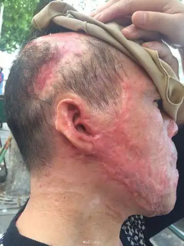 全身大面积烧伤半年