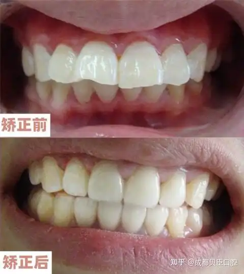 龅牙整牙内收八毫米是什么概念? - 知乎