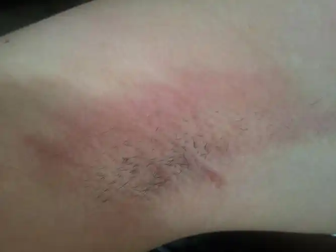 腋臭微创手术后发红的皮肤怎么治疗啊