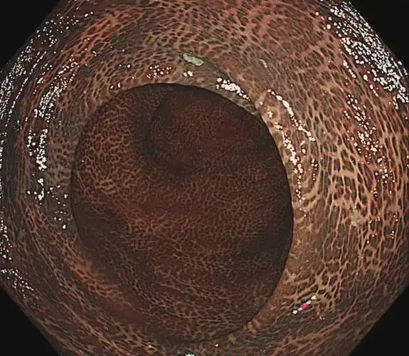 中药治便秘,不只是泻火这么简单——滥用中成药,警惕结肠黑变病