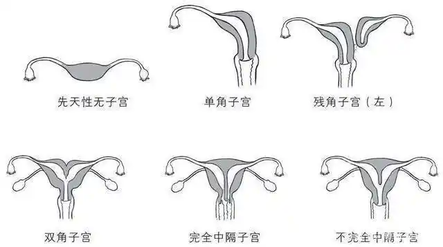 幼稚子宫与始基子宫能怀孕吗?