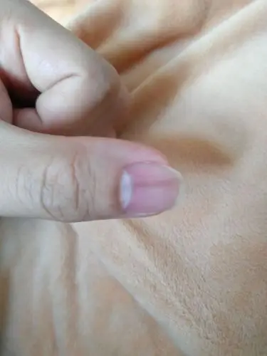 指甲出现黑色竖条是怎么回事?