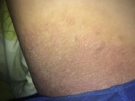 体癣的常见治疗方法