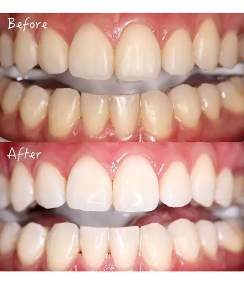 牙齿美白居然这么简单听听口腔专家怎么说