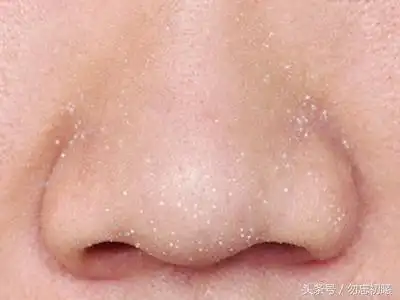 什么是白头粉刺,满脸白头粉刺(最招年轻人恨的面部问题)