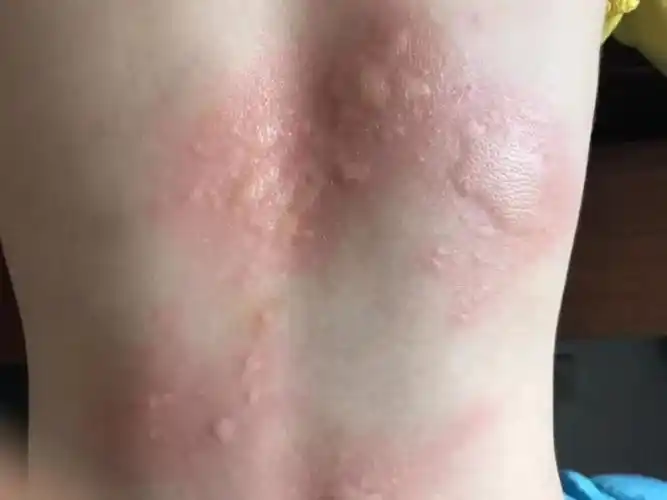 宝宝这一年的荨麻疹,居然是积食惹的祸