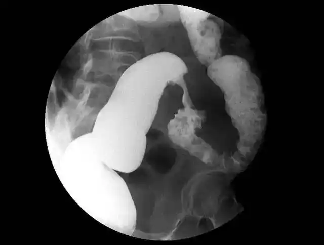 掌握肠道造影看这篇就够了