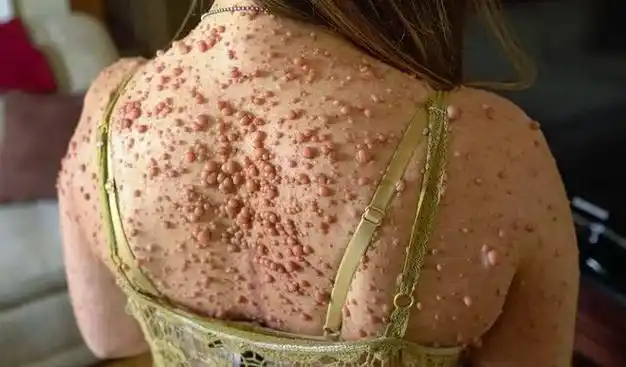 你知道神经纤维瘤病该怎么治疗吗?来了解一下!