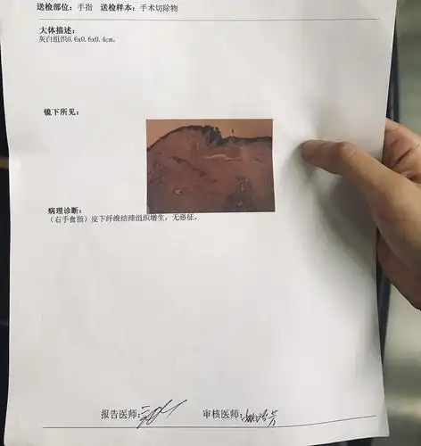 有没有姐妹长过甲母痣就是指甲上有一条黑线的那种