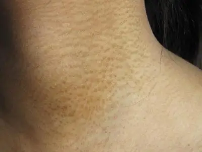 如何做能预防黑棘皮病