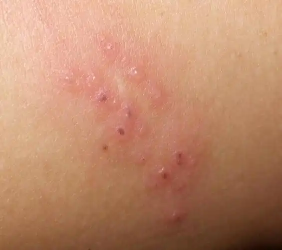 知道这是什么虫子咬的