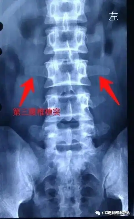 经常腰痛的你也许得了腰三横突综合征