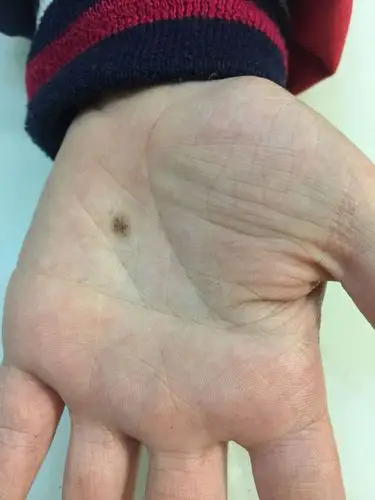 手心的痣,建议及时去掉.