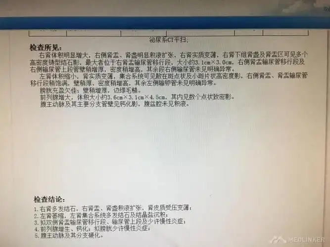 诊断 处理诊断: 1.右肾结石多发 2.右肾积水 3.左肾结石多发 4.