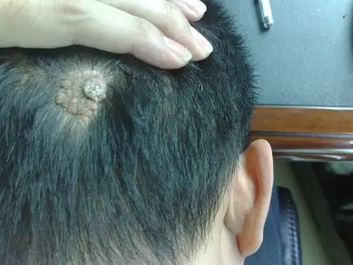 头皮后脑上长东西