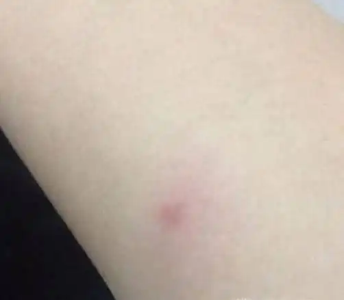 结果判断以硬结直径为标准