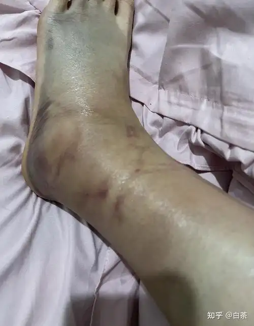 脚踝左腓骨远端骨折月记