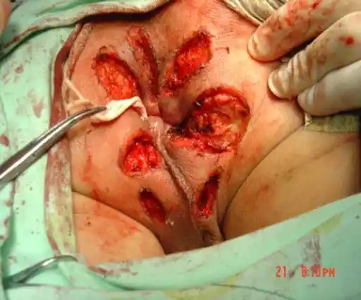 肛腺全切除术治疗复杂性肛瘘