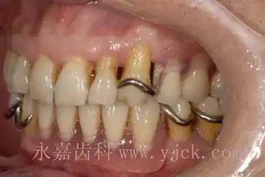 纯钛支架一种理想的活动义齿修复方式