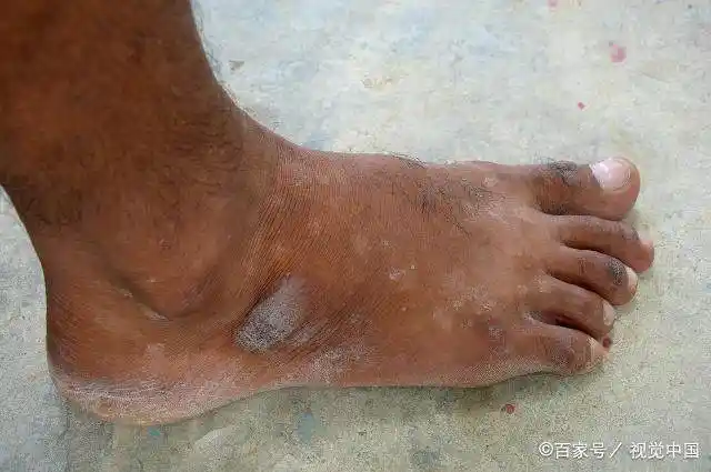 62岁大爷脚部出现异样被确诊肝癌赶紧记下这些癌症信号