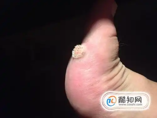 跖疣长什么样子脚上跖疣图片优质