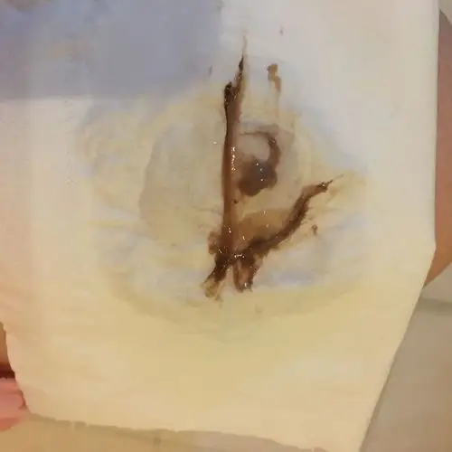 满意回答 您好,您的情况是白带带血,这一般是有妇科炎症比如宫颈糜