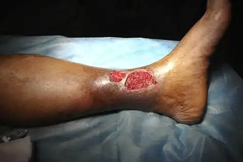 用博落回冰片臁疮散治臁疮老烂腿68例全部治愈