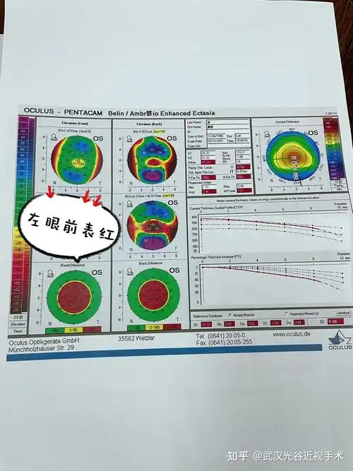 近视手术安全圆锥角膜