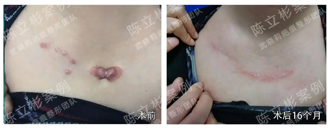 现术后16个月略充血,未增生变宽,仍有部分充血,总体趋稳定,恢复不错