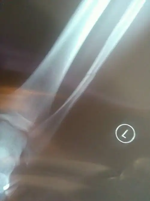 医生您好,我小腿腓骨骨折,没错位,没打石膏,没手术,也没做任何固定