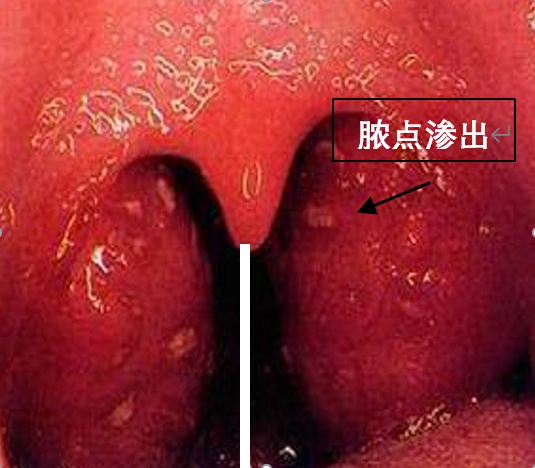 记住2个标记,第一是咽腭弓,第二是中线.