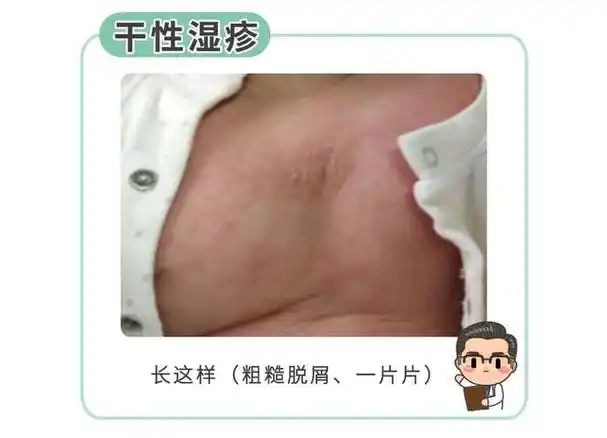 不少妈妈会把热疹和干性湿疹混淆,干性湿疹高发,记住几点就够了_健康
