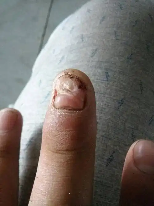 因工伤导致手指甲盖掉了,长出来变形了,能不能向公司索要赔偿