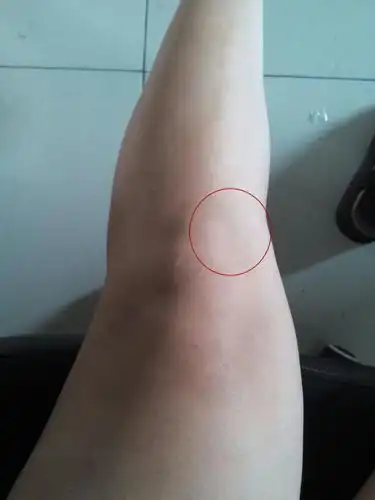 跳一次广场舞回来,膝盖内侧偏下方,一碰就有酸痛的感觉,也不肿.