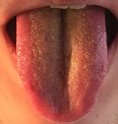 帮忙看看我的舌苔,很多,而且厚 黄 有锯齿,刷牙从来没刷过舌头,但是听