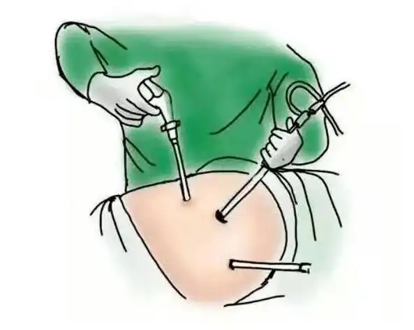 火眼金晴腹腔镜,照得隐匿病灶无处藏!_手术_康达_赵先生