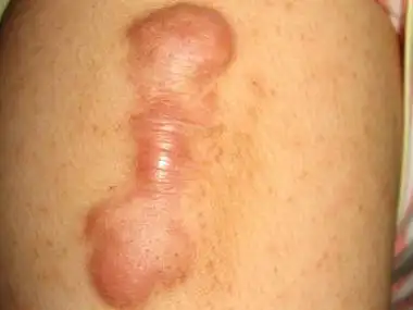 瘢痕疙瘩的护理方法有哪些 - 鉴别护理 - 瘢痕疙瘩 - 北京京城皮肤