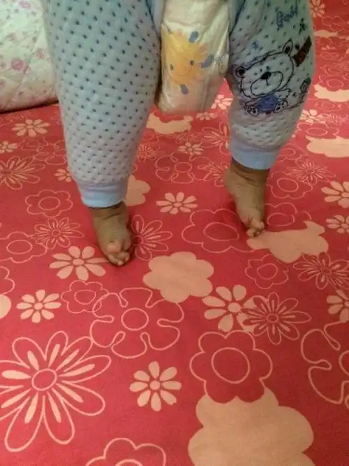 两脚外翻.站立时脚不能平放.请问是什么问题怎么治疗