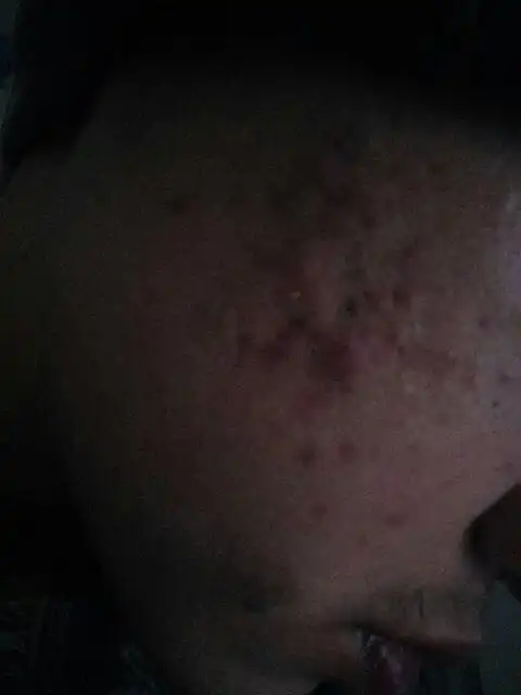 这脸上的痘痘肿了黑了一块肿么办,被同学当笑话说了,感觉台不起头了