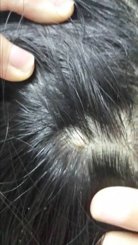 今天发现头皮上有个疙瘩,和皮肤一个色,不