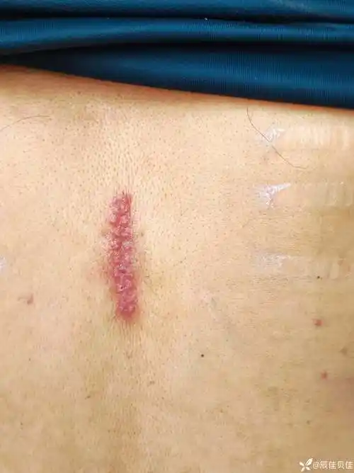 皮脂腺囊肿早期切开引流二期缝合经过