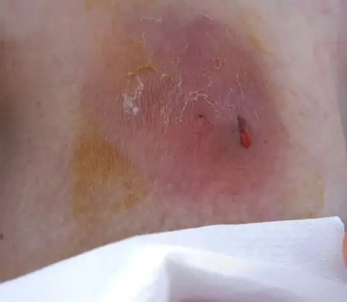 乳腺炎(mastitis)成因,预防和治疗