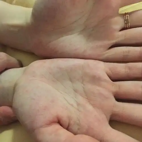 不知不觉手掌起啦好多小红点,没有感觉,看着吓人,请问这是怎么回事