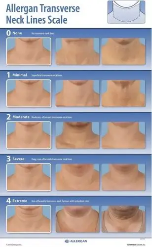 长了多年的火鸡脖子,被肉毒毒素给救了