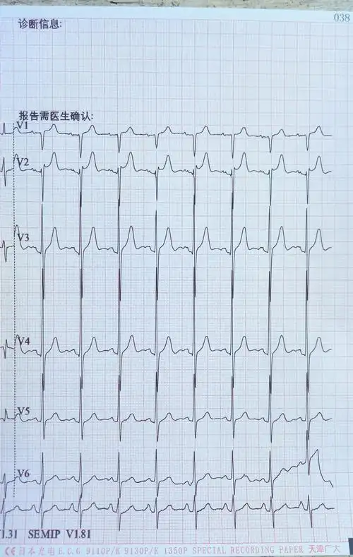 异常q波? - 心电图脑电图专业讨论版 - 爱爱医医学论坛