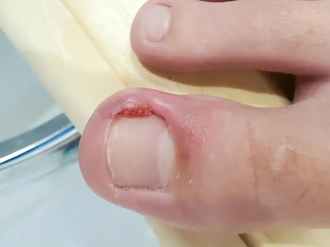 大拇指的指甲往肉里长,最常见的原因是由于大拇指的负重功能最强